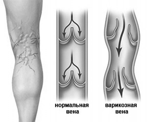 Варикозное расширение вен: причины и первые симптомы, почему к заболеванию склонны пожилые люди Варикозное расширение вен: причины и первые симптомы, почему к заболеванию склонны пожилые люди
