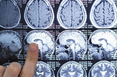 FDA одобрило первый препарат для терапии диффузных глиом FDA одобрило первый препарат для терапии диффузных глиом
