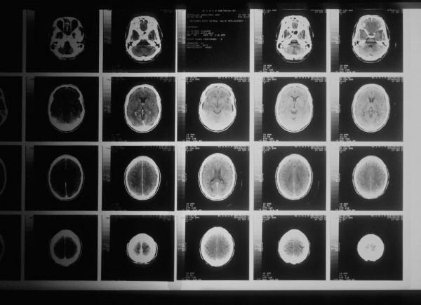 Из-за коронавируса мозг под ударом Из-за коронавируса мозг под ударом